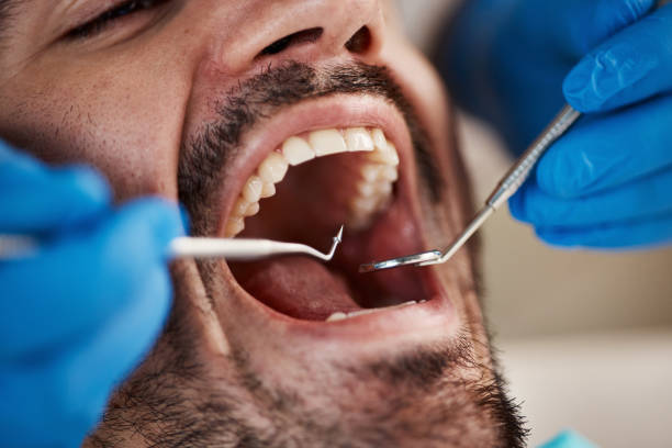 Best Emergency Wisdom Teeth Removal in Lawrencevle, IL